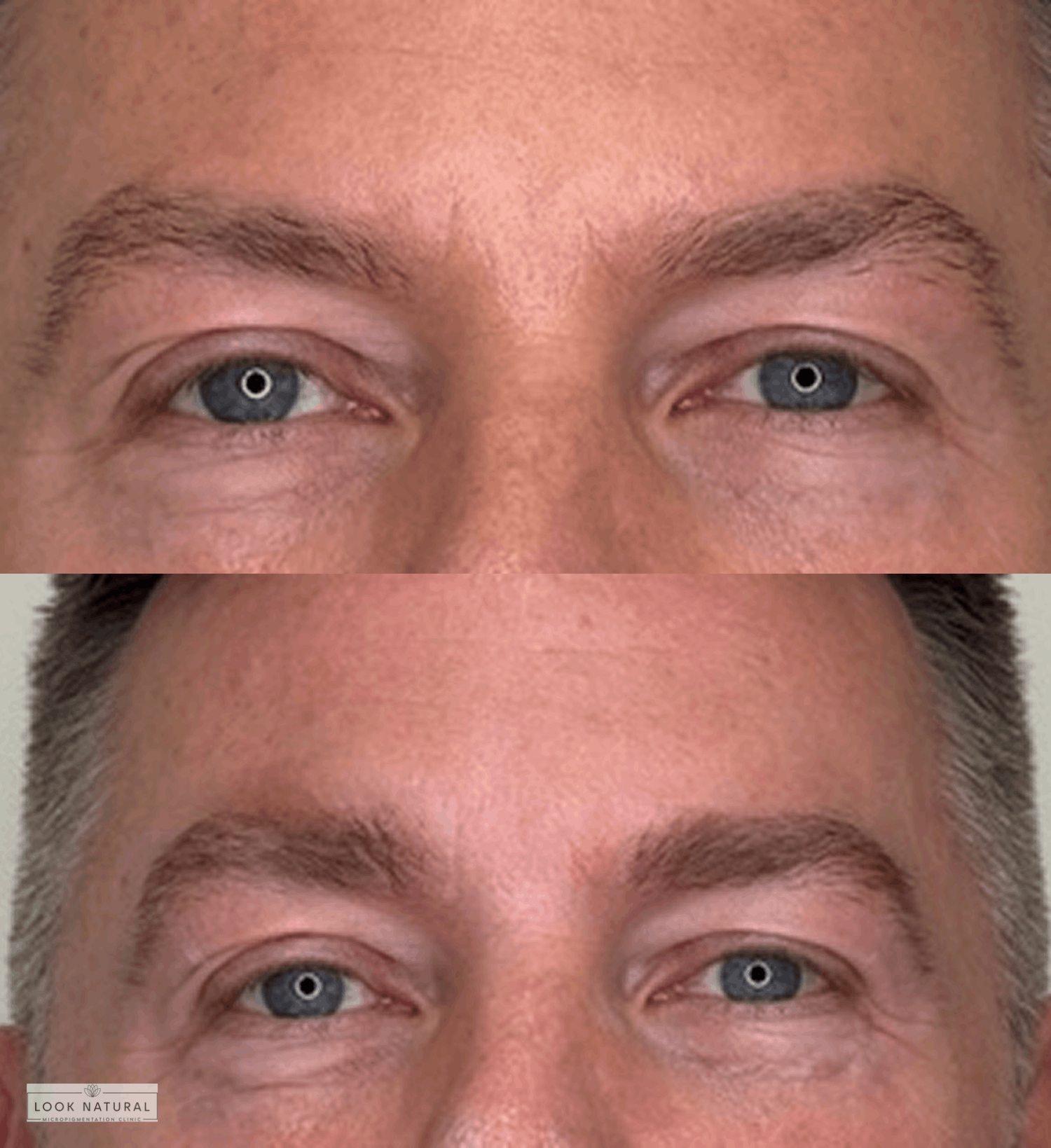 Before and after results of men’s eyebrow restoration with enhanced thickness and natural look.