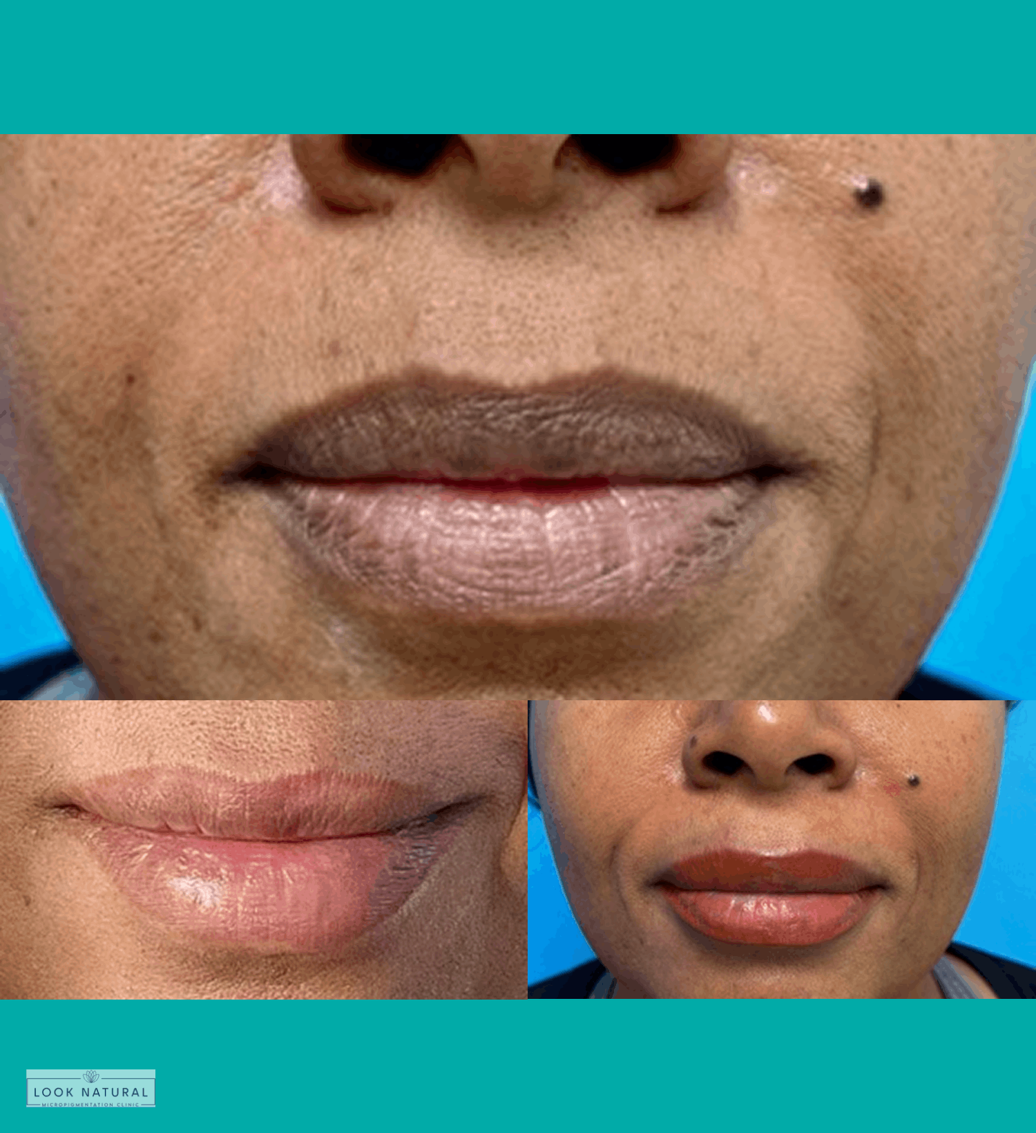 Professional lip neutralization and lightening before and after treatment