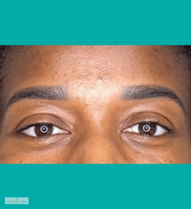 Well-defined eyebrow restoration creating symmetrical brows.