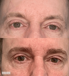 Before and after men’s eyebrow restoration showing naturally enhanced, fuller brows.