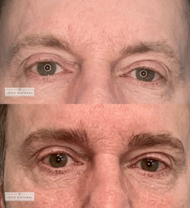 Before and after image of a man’s eyebrow restoration treatment with natural enhancement.