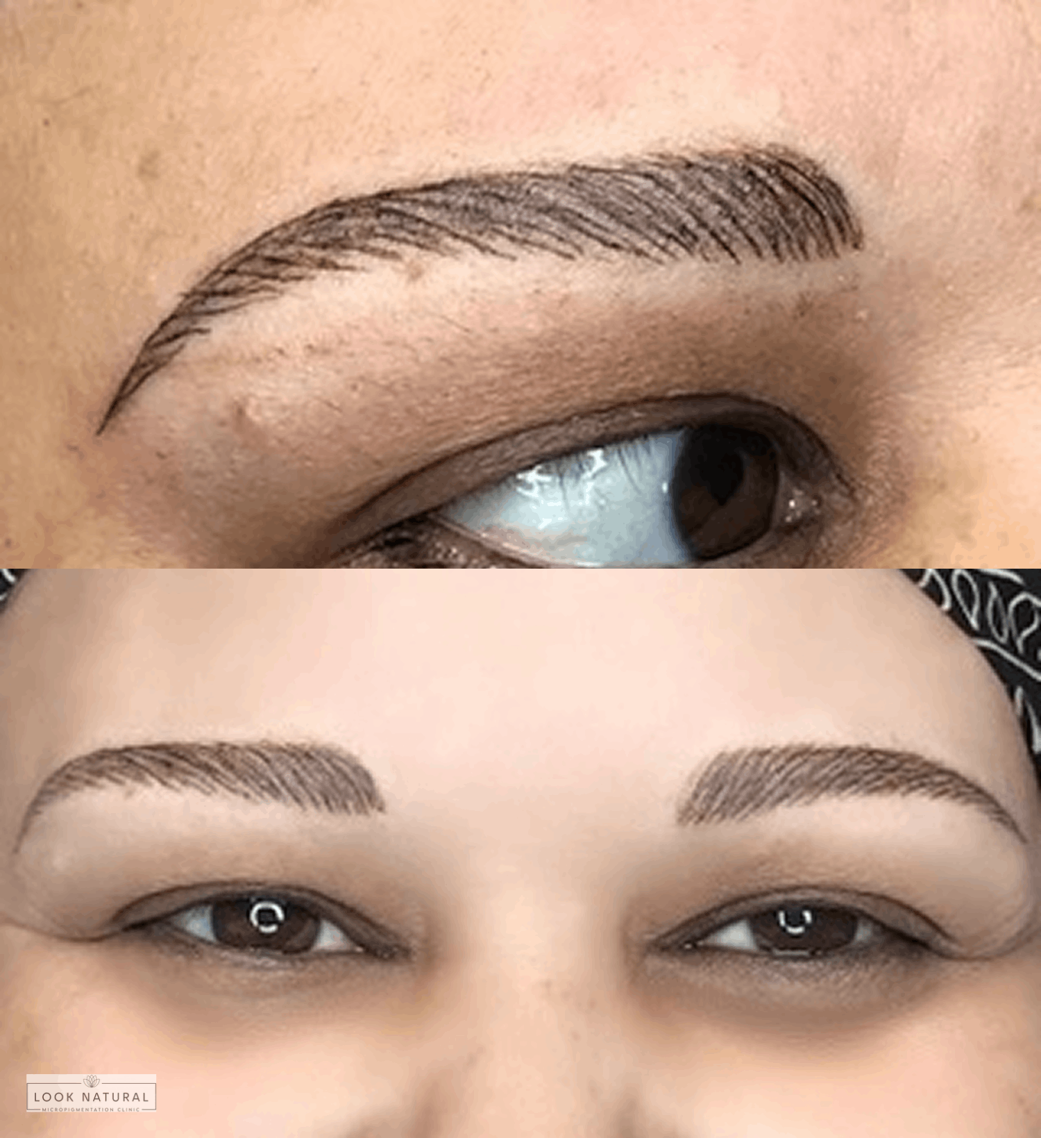 Eyebrow restoration showing fuller, natural-looking brows after treatment.