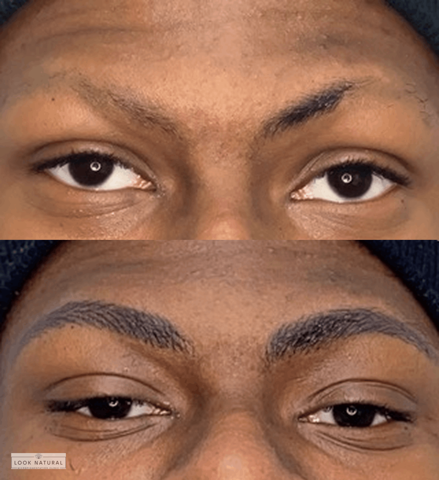 Before and after results of men’s eyebrow restoration showing fuller, well-shaped brows.