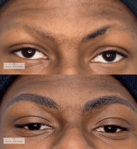 Before and after image of a man’s eyebrow restoration showing fuller, well-shaped brows.