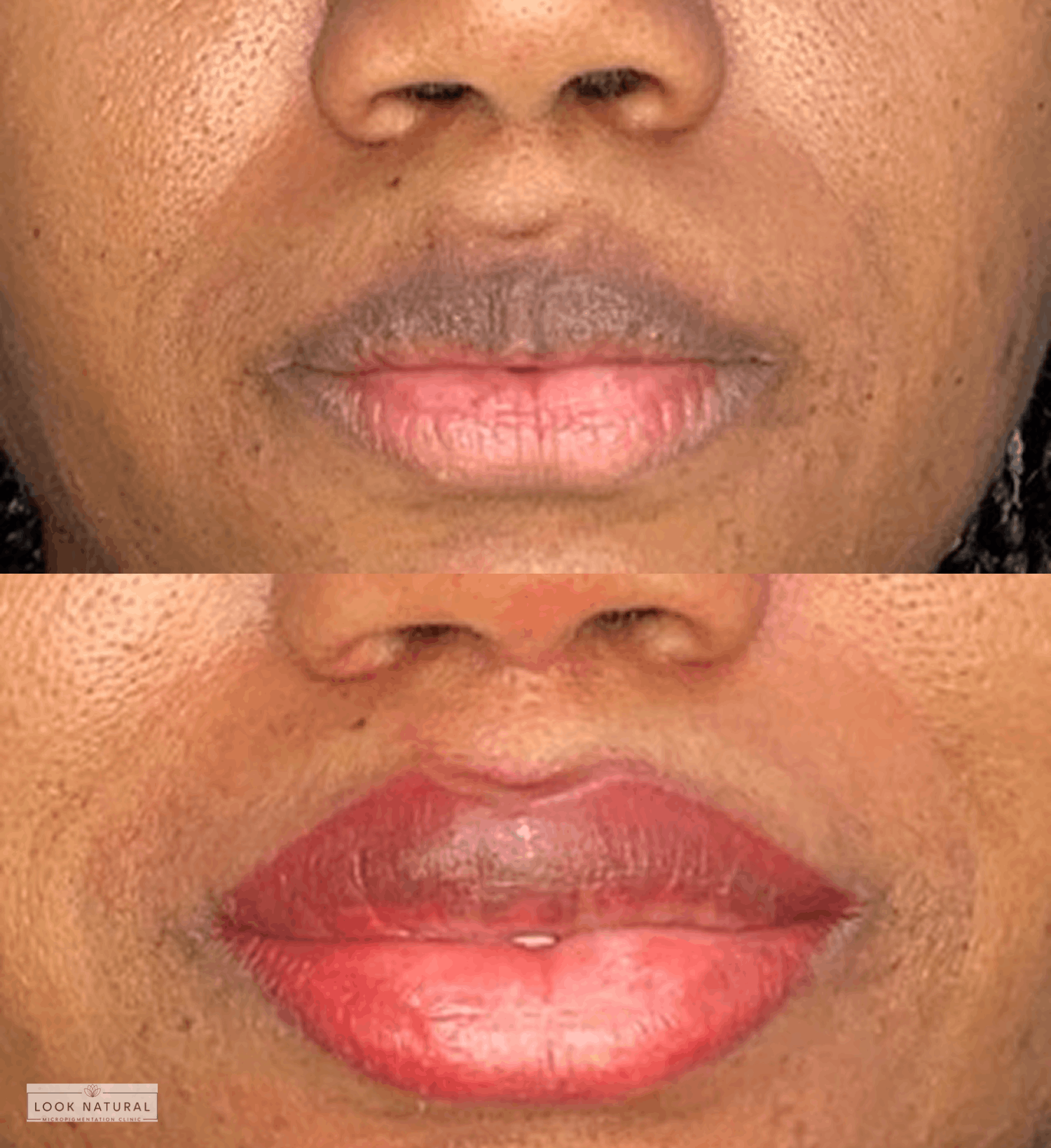 Female lip neutralization and lightening treatment showing before and after transformation