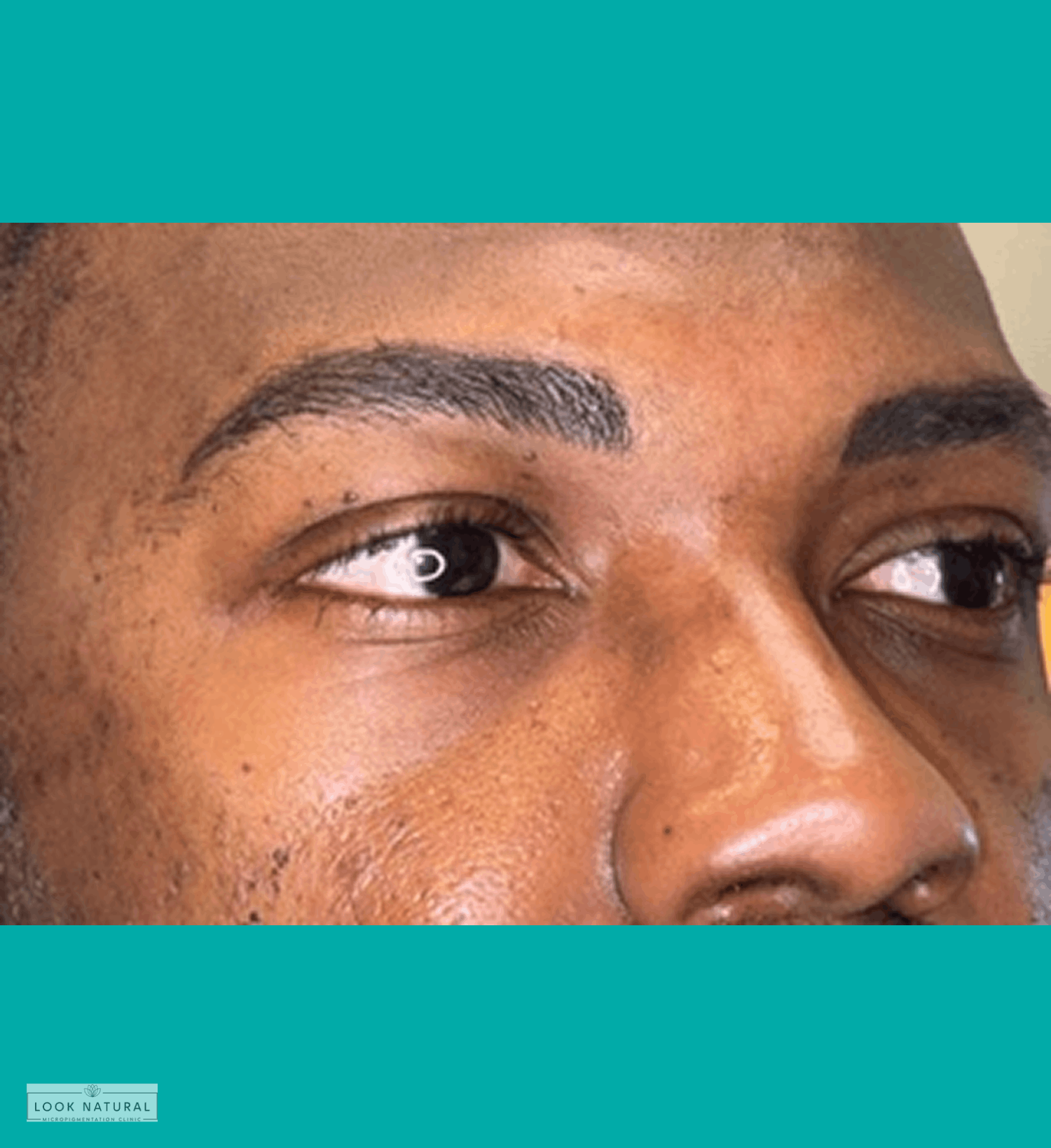 Men’s eyebrow restoration showing defined, fuller brows with a natural look.