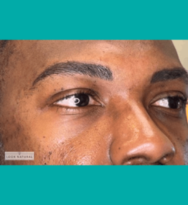 Close-up view of a man’s restored eyebrows after professional eyebrow restoration treatment.