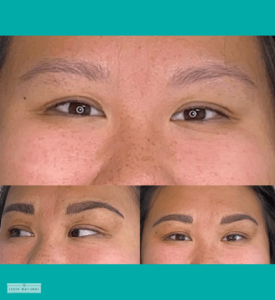 Before and after results of eyebrow restoration adding shape and fullness to naturally sparse brows.