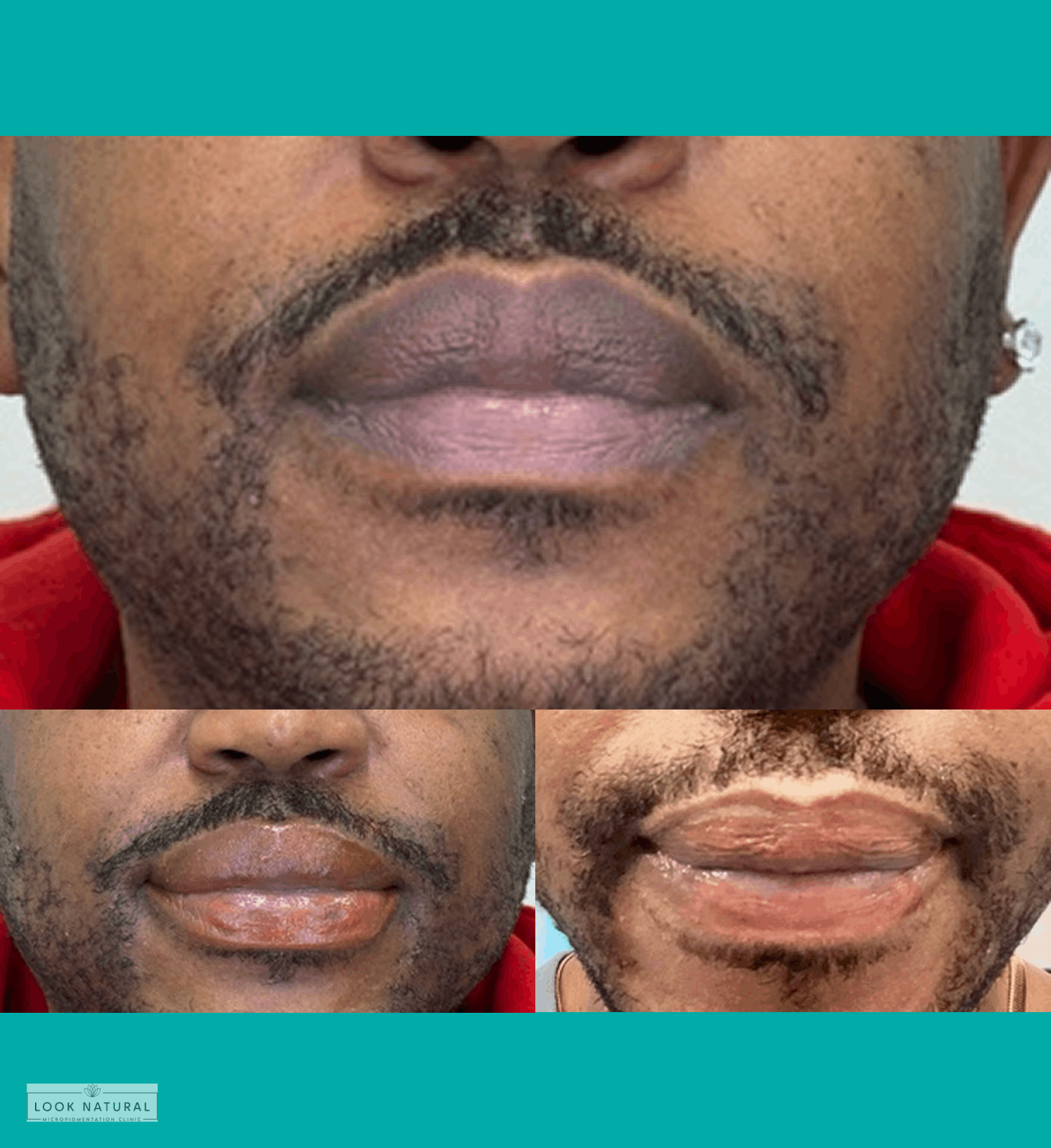 Male lip neutralization and lightening treatment before and after results