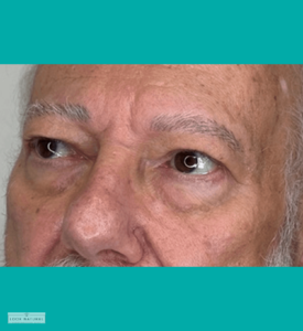 Men’s eyebrow restoration treatment for mature brows, creating a fuller, youthful appearance.