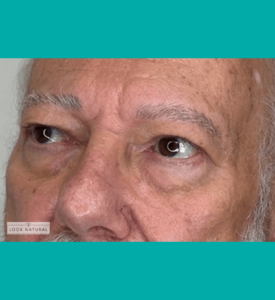 Before eyebrow restoration showing thinning brows in an elderly male client.