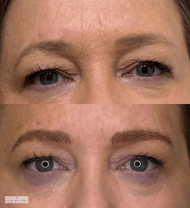 Before and after eyebrow restoration showcasing transformation from thinning brows to naturally fuller, well-shaped eyebrows.