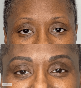 Before and after eyebrow restoration showing natural volume and beautifully shaped brows for a more defined look.