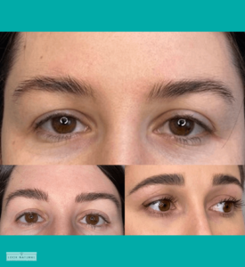 Before and after eyebrow restoration showing natural fullness and enhanced shape for a youthful look.