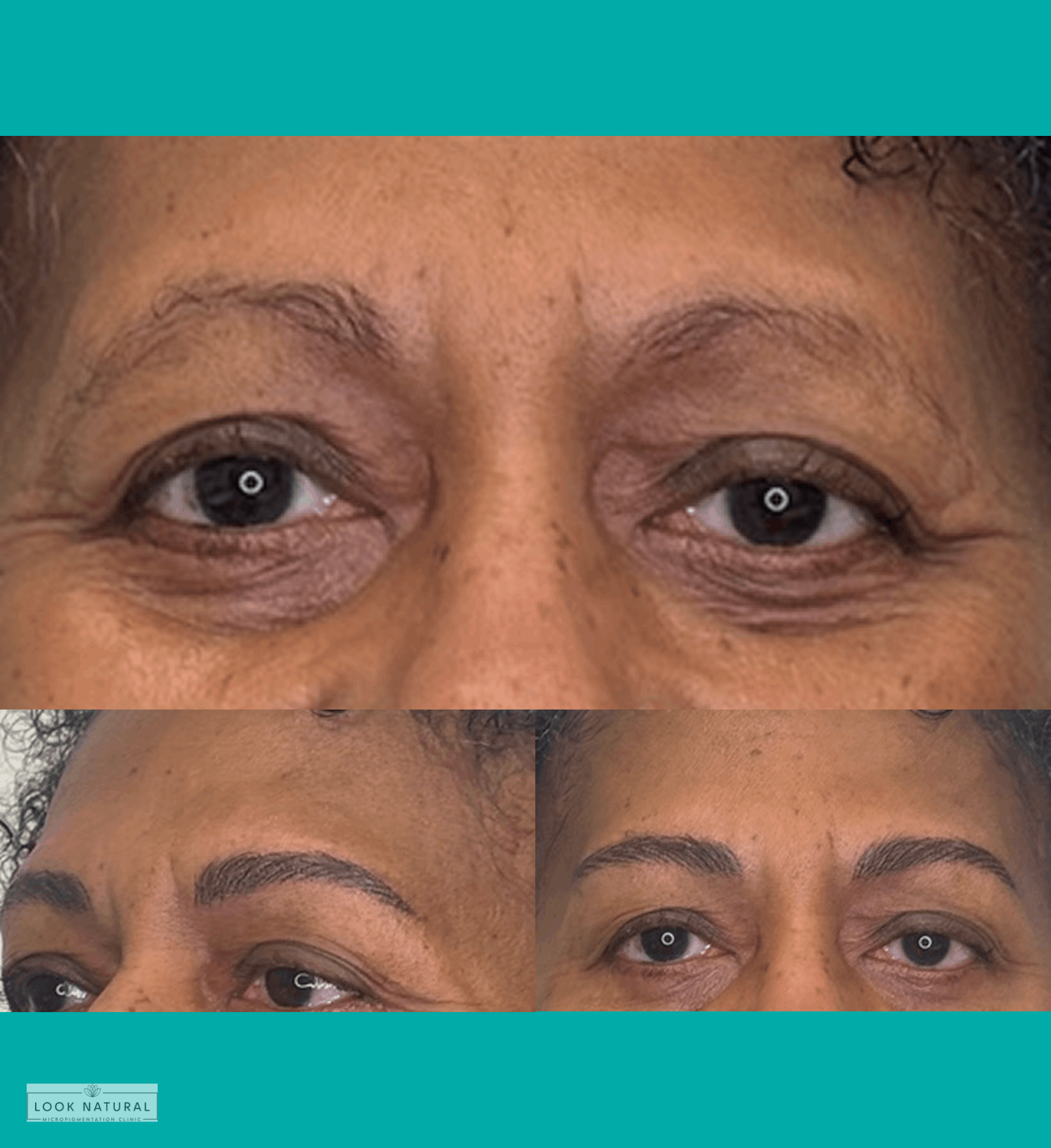 Before and after results of women’s eyebrow restoration showing transformation from sparse, thinning brows to natural, fuller eyebrows.