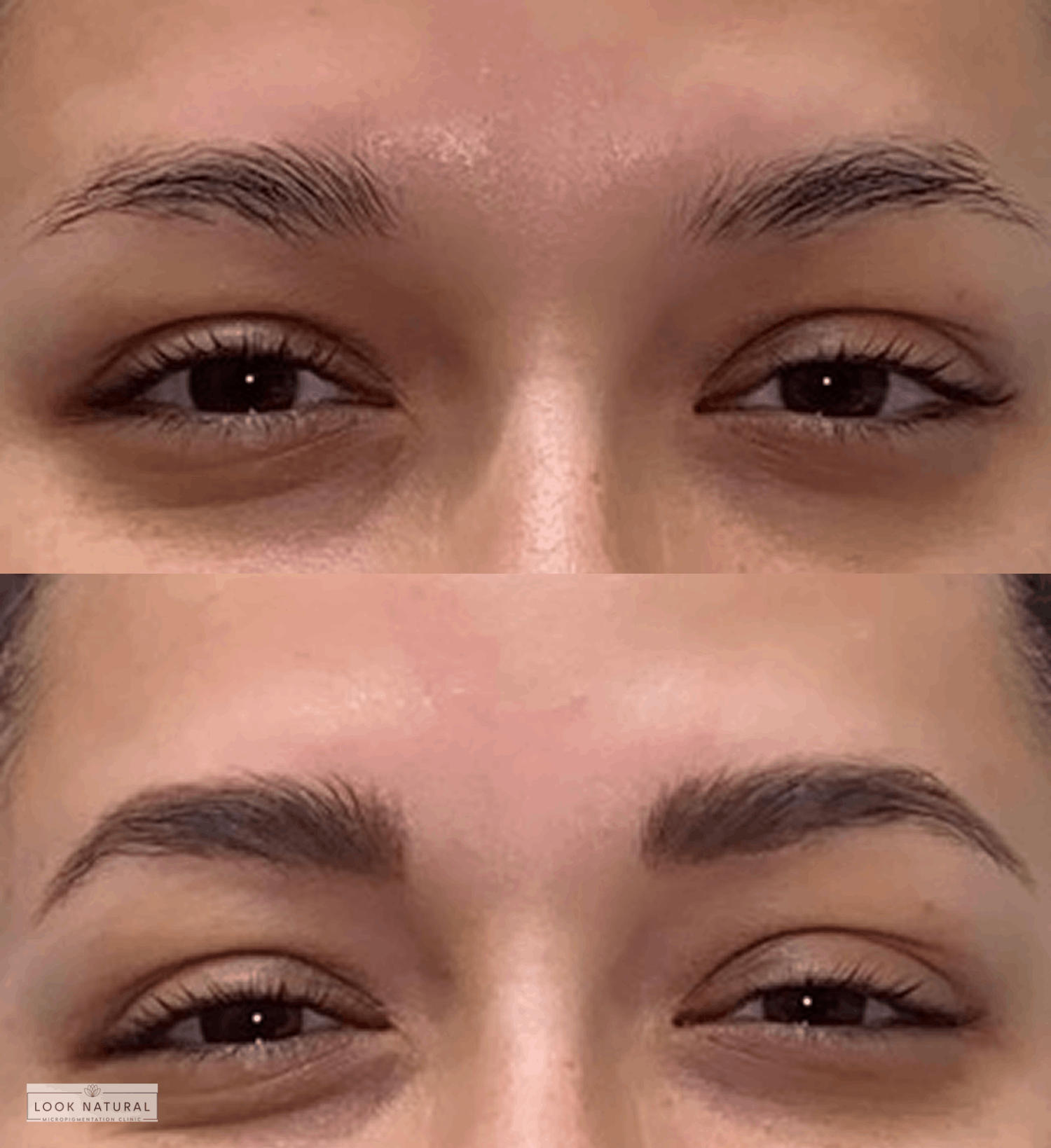 Before and after results of women’s eyebrow restoration showing transformation from uneven, thin brows to well-shaped, fuller eyebrows.
