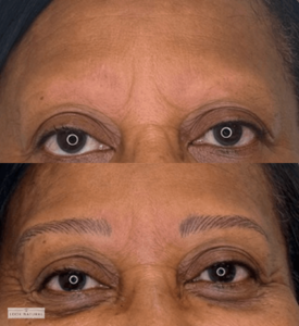 Before and after of women’s eyebrow restoration showing transformation from sparse to naturally full eyebrows.