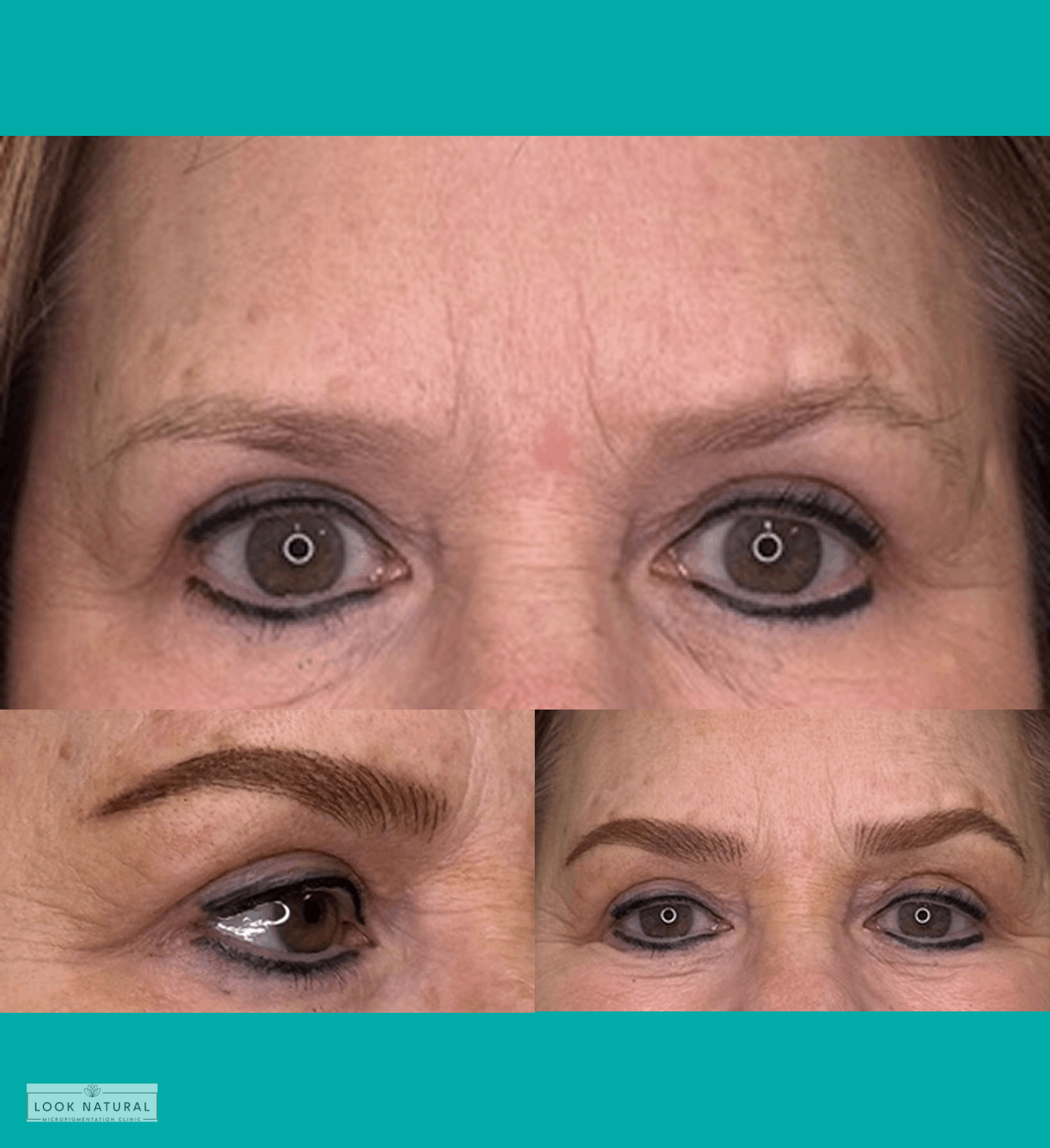 Before and after results of women’s eyebrow restoration showing natural, fuller brows with improved shape.