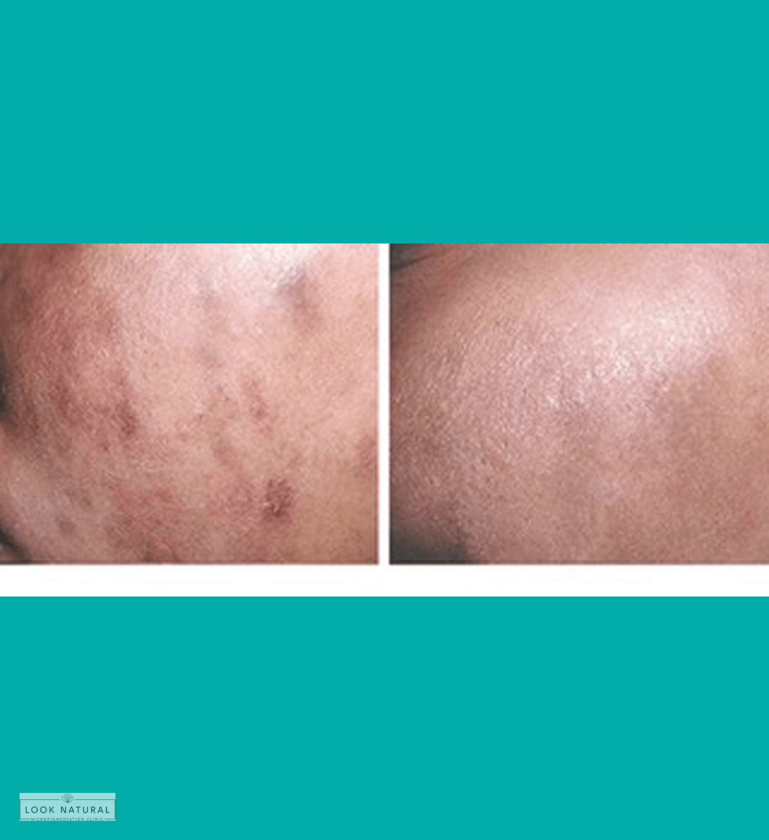 Before and after facial scar camouflage treatment for acne scarring