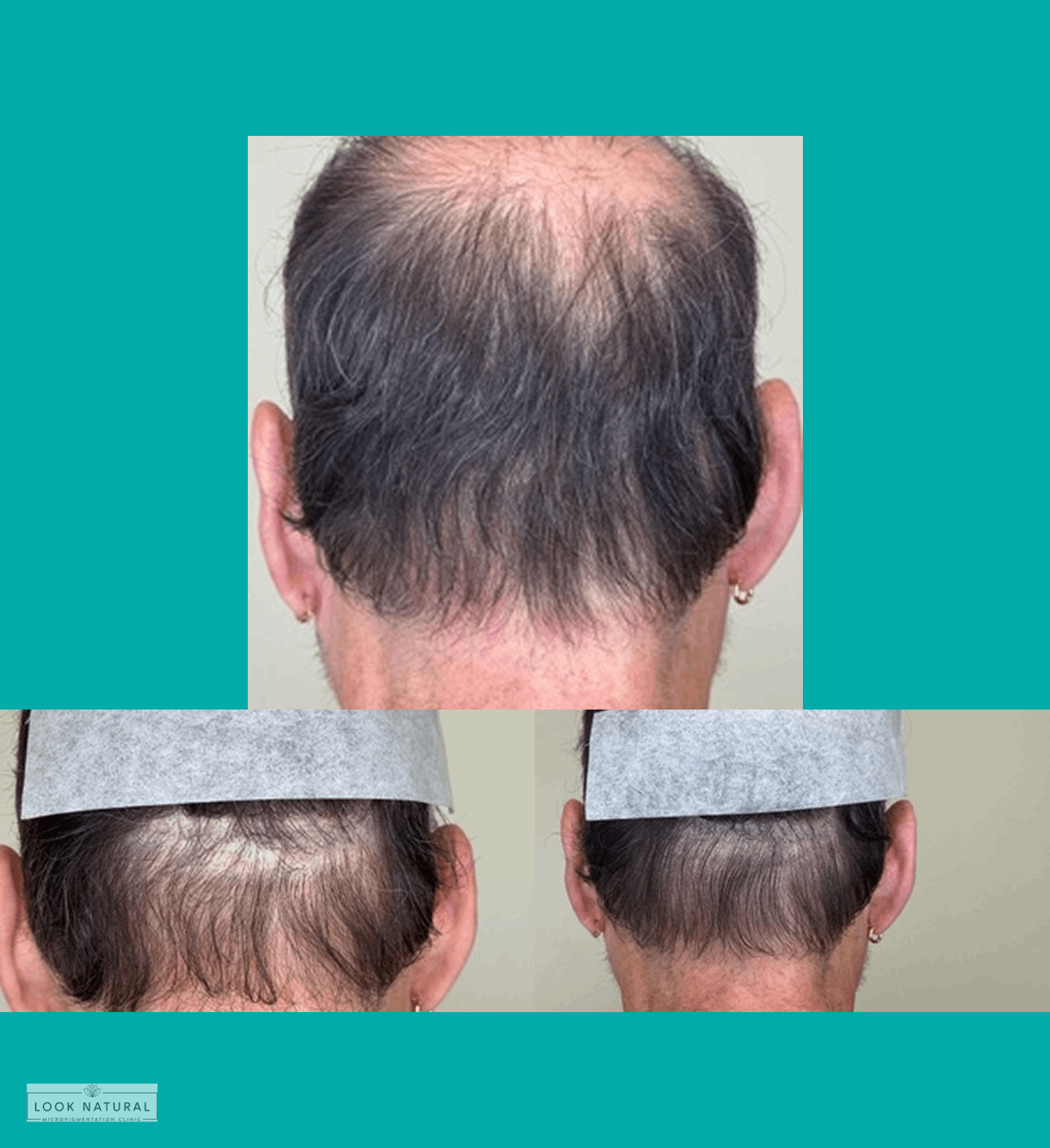 Before and after scalp micropigmentation treatment for bald spot coverage