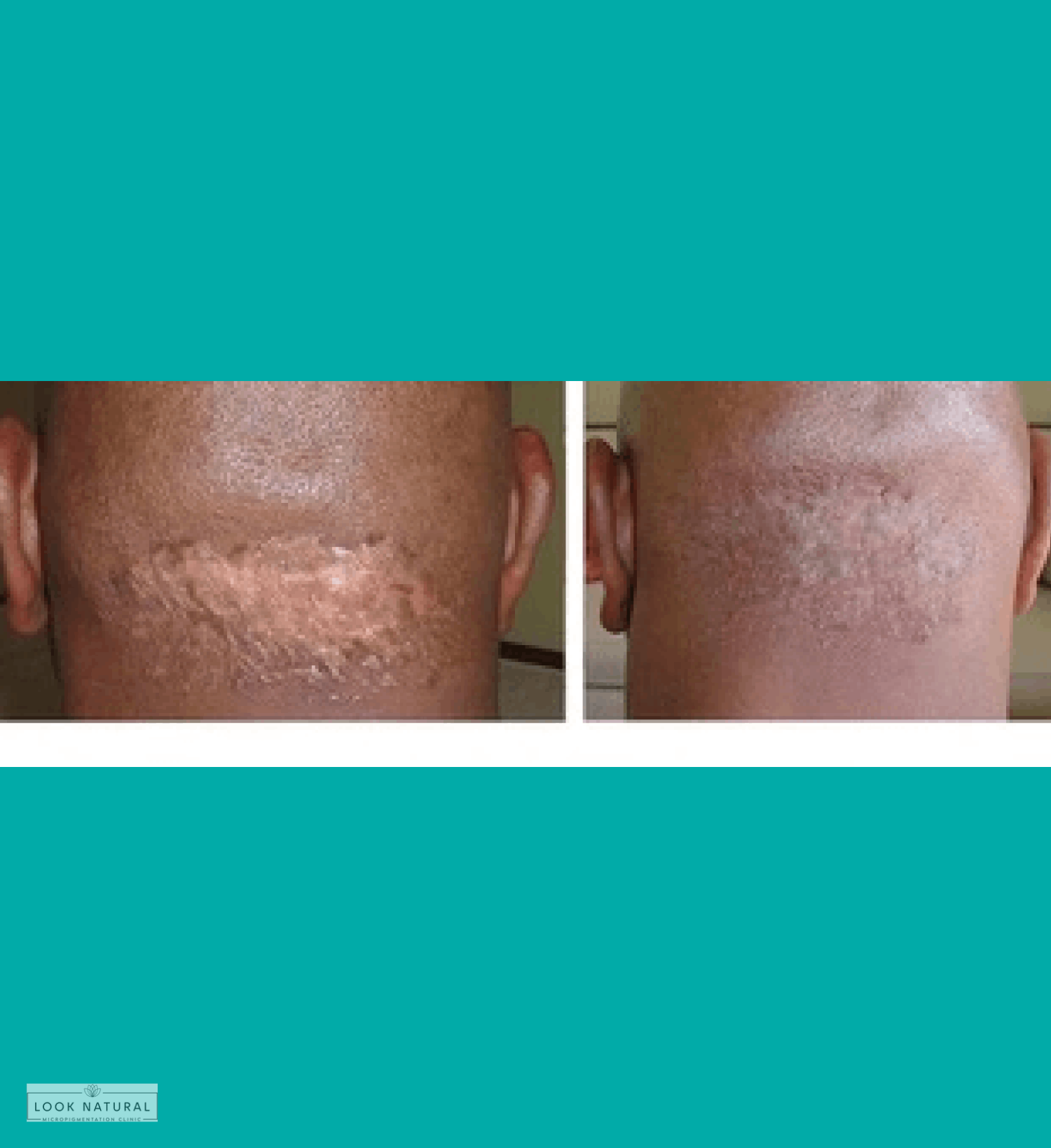 Before and after scalp scar camouflage treatment on back of head