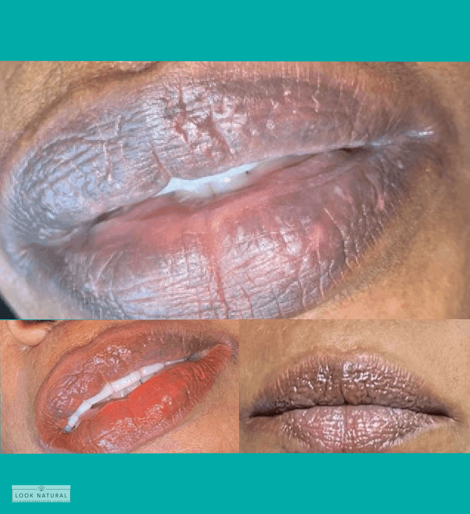 Stages of lip neutralization treatment on dark lips showing color correction process