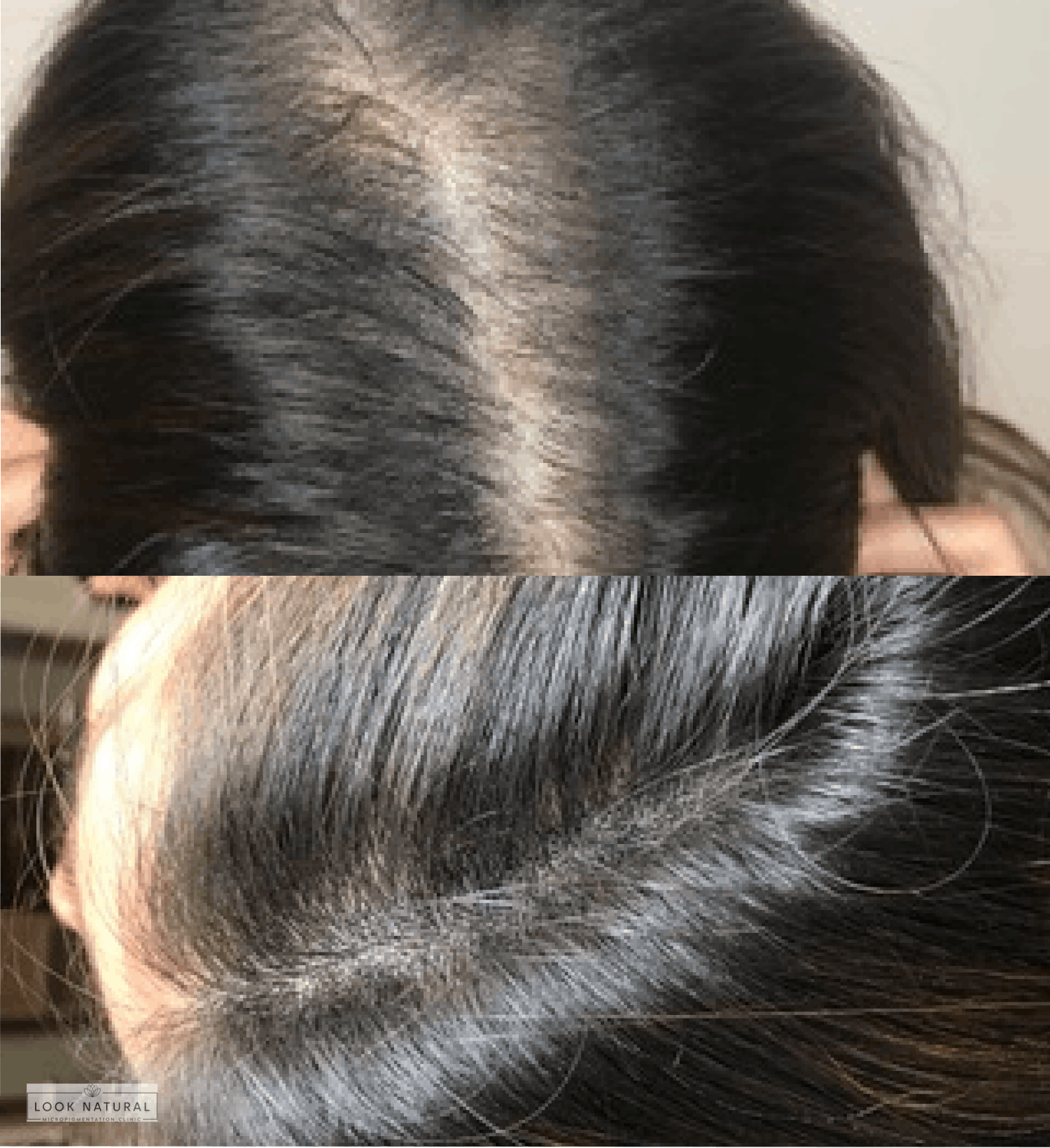 Before and after scalp micropigmentation treatment for hair thinning