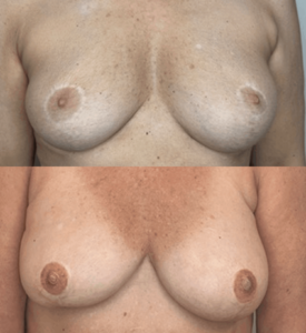3D nipple and areola tattooing before and after breast reconstruction