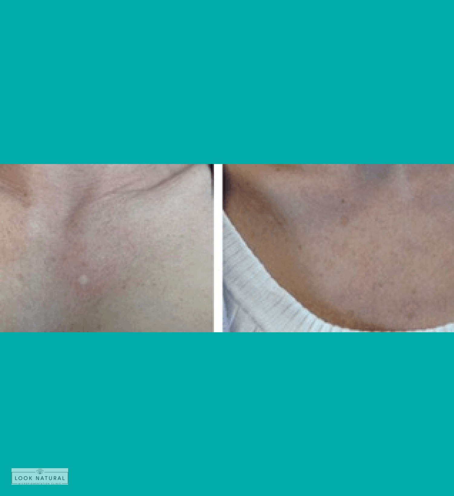 Before and after chest scar camouflage treatment for improved skin tone