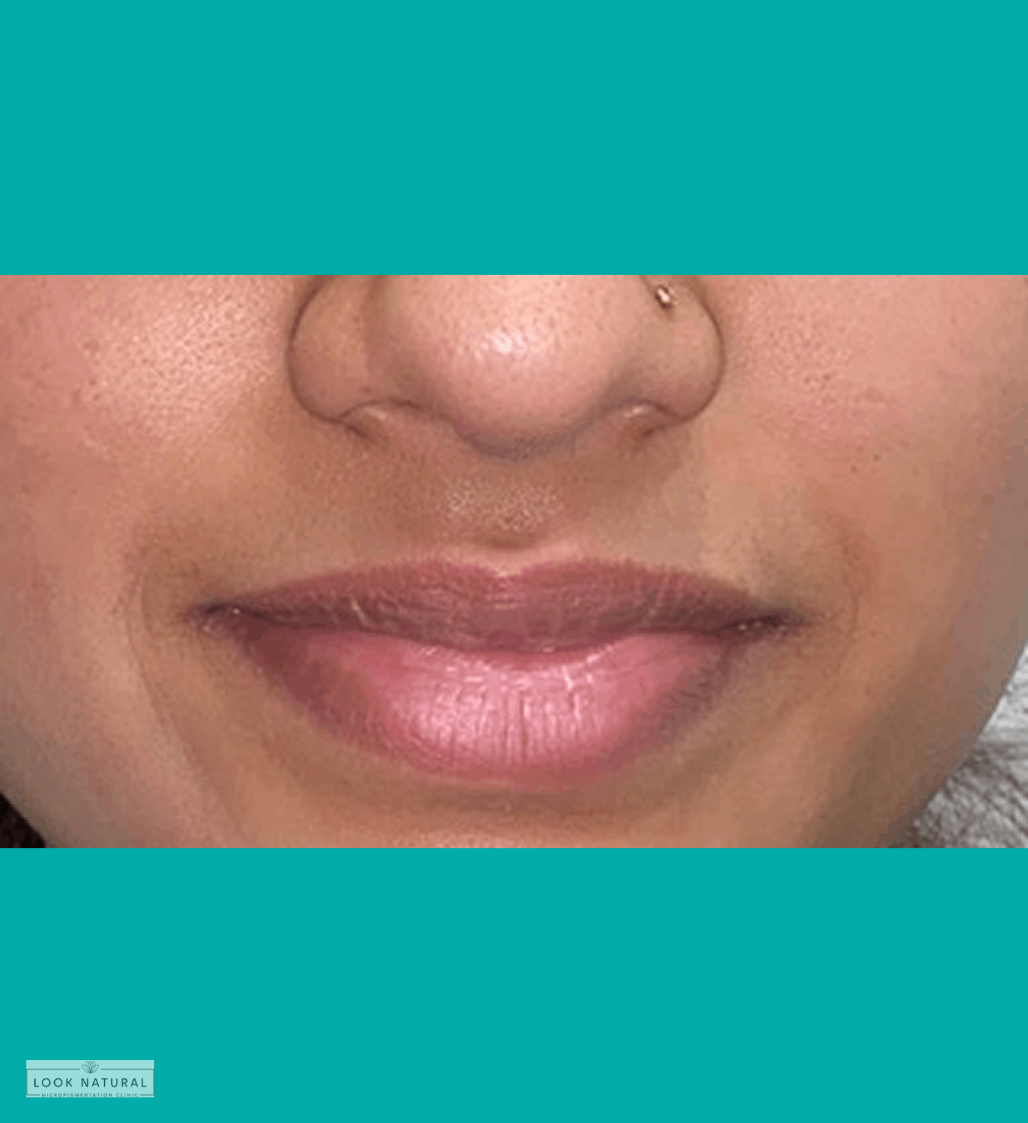 Lip neutralization procedure result for soft pink lips on medium skin tone