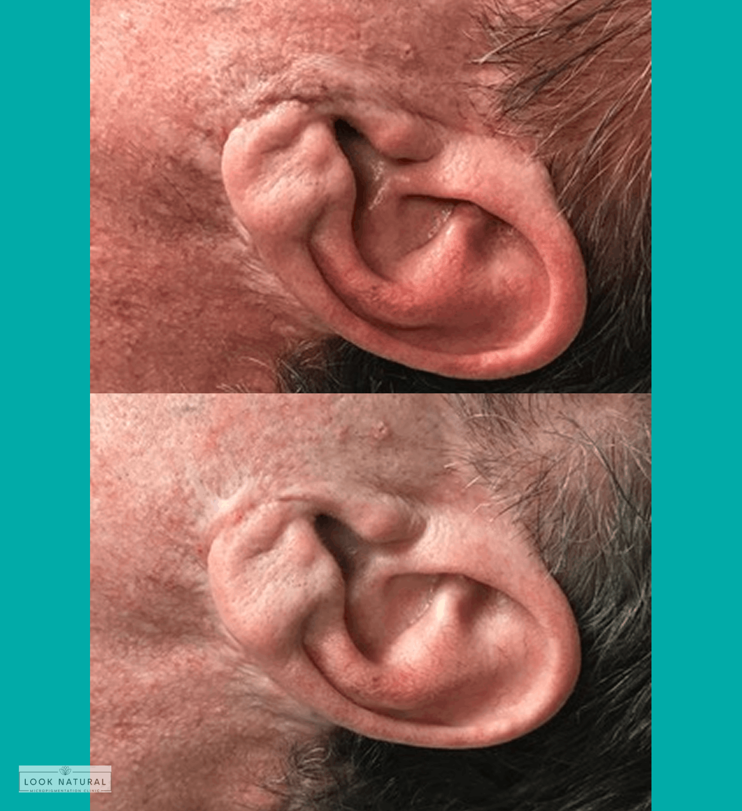 Before and after scar camouflage treatment on ear