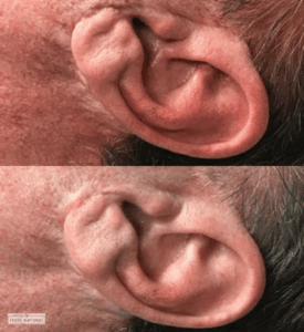 Before and after ear scar camouflage treatment on male client