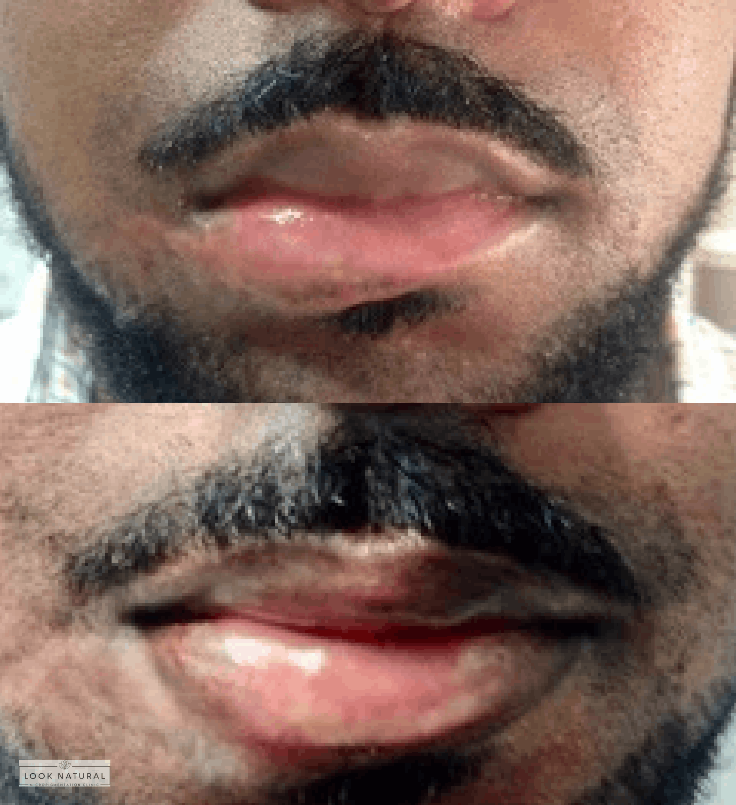 Before and after lip scar camouflage treatment for male client
