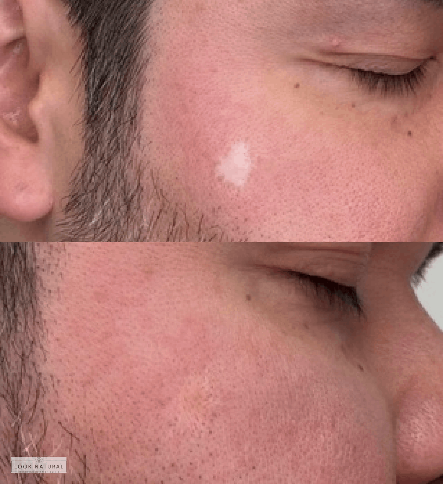 Before and after camouflage treatment for facial skin discoloration on cheek