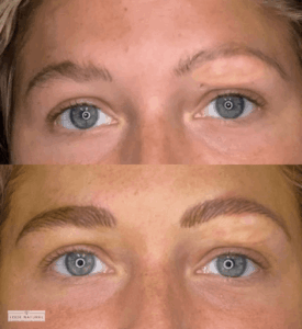 Before and after eyebrow micropigmentation treatment covering brow scar