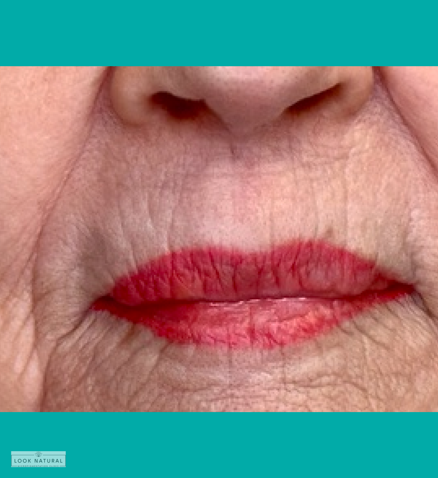 Semi-permanent lip liner treatment on mature lips with red pigment