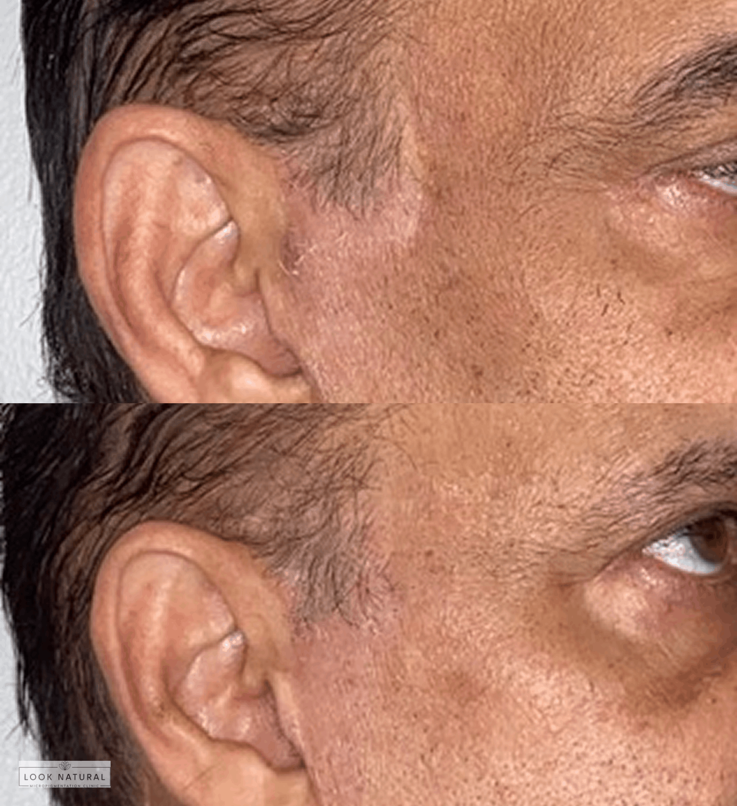 Before and after facial scar camouflage treatment near hairline and ear