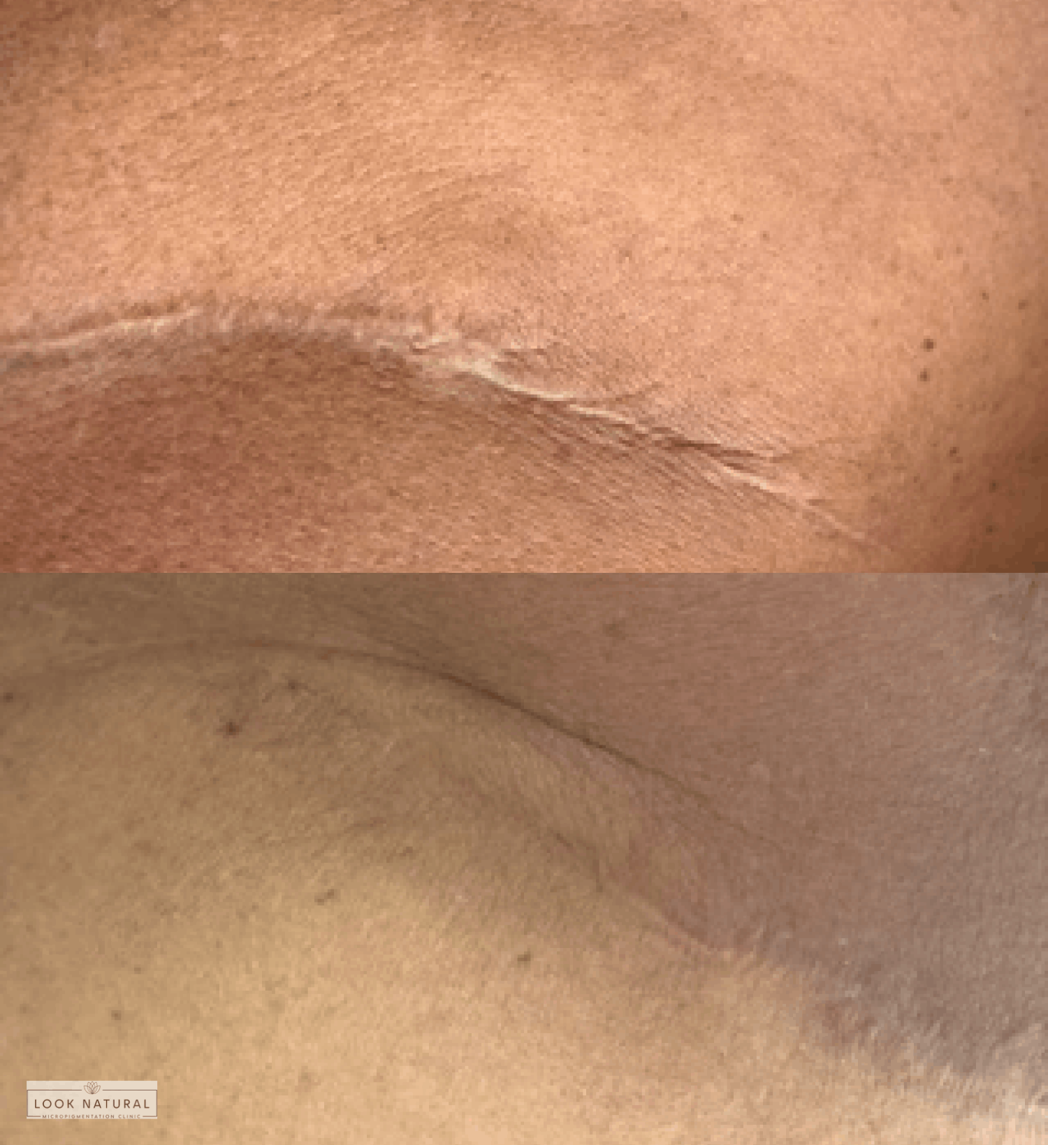 Before and after body scar camouflage treatment on lower abdomen
