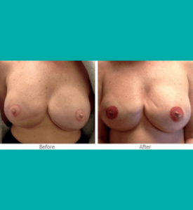 11_3-D Nipple & Areola Tattooing | Look Natural Micropigmentation Clinic Before and after 3D nipple areola tattooing showing enhanced pigmentation and natural-looking breast reconstruction