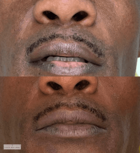 Before and after upper lip scar camouflage treatment for male client