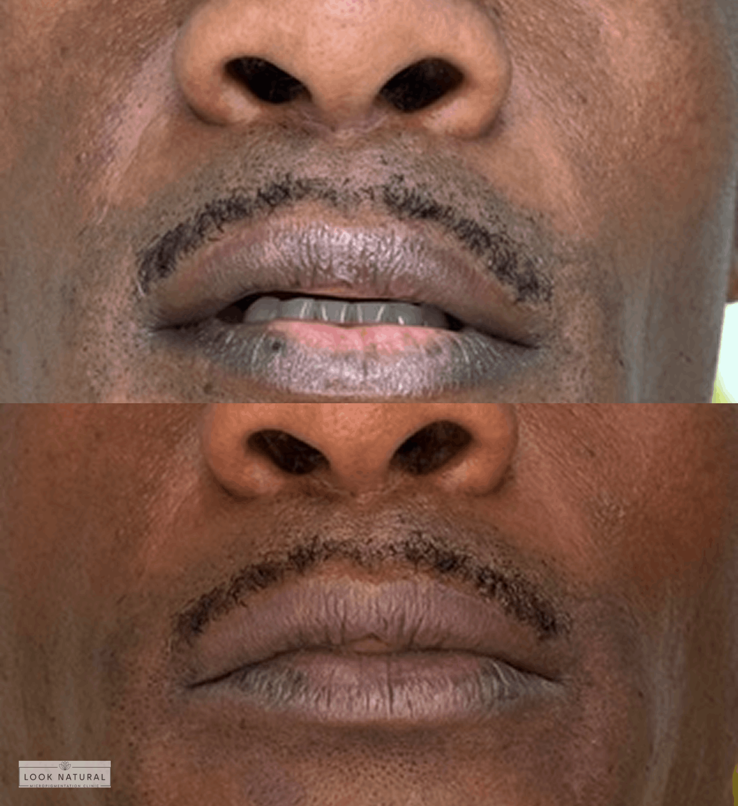 Before and after upper lip scar camouflage treatment for male client