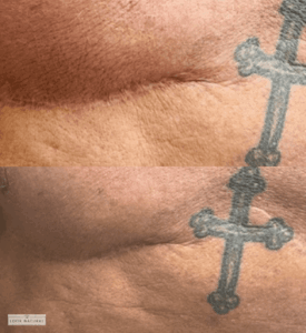 Before and after scar camouflage treatment on lower abdomen with tattoo nearby