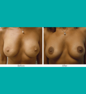 Before and after 3D nipple areola tattooing showing improved breast pigmentation and symmetry