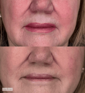 Before and after lip scar camouflage treatment on mature female client