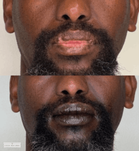 Before and after facial scar camouflage treatment on lips of male client