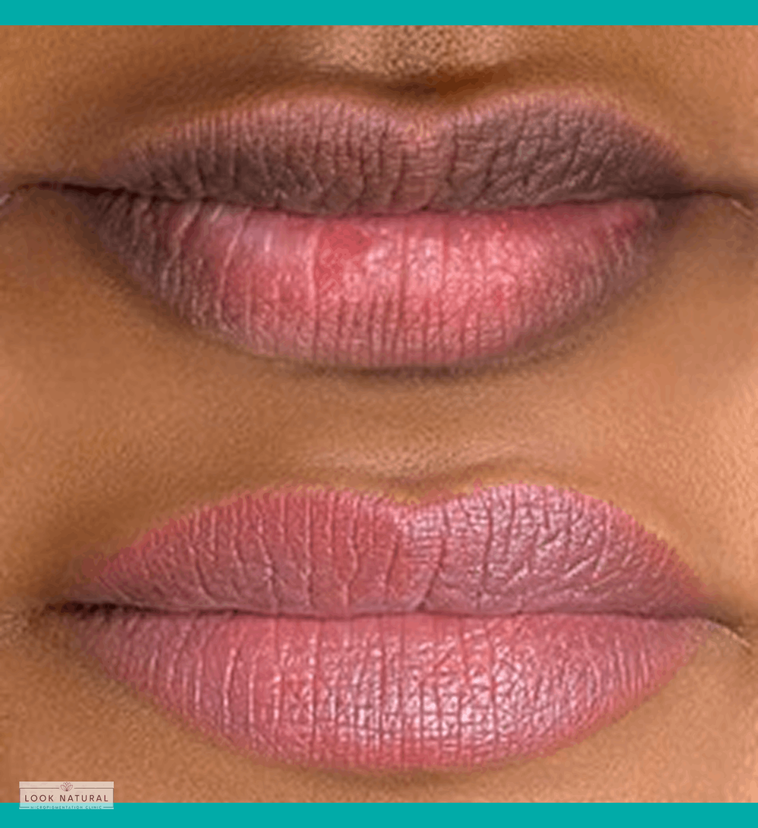 Before and after lip neutralization treatment for dark lips