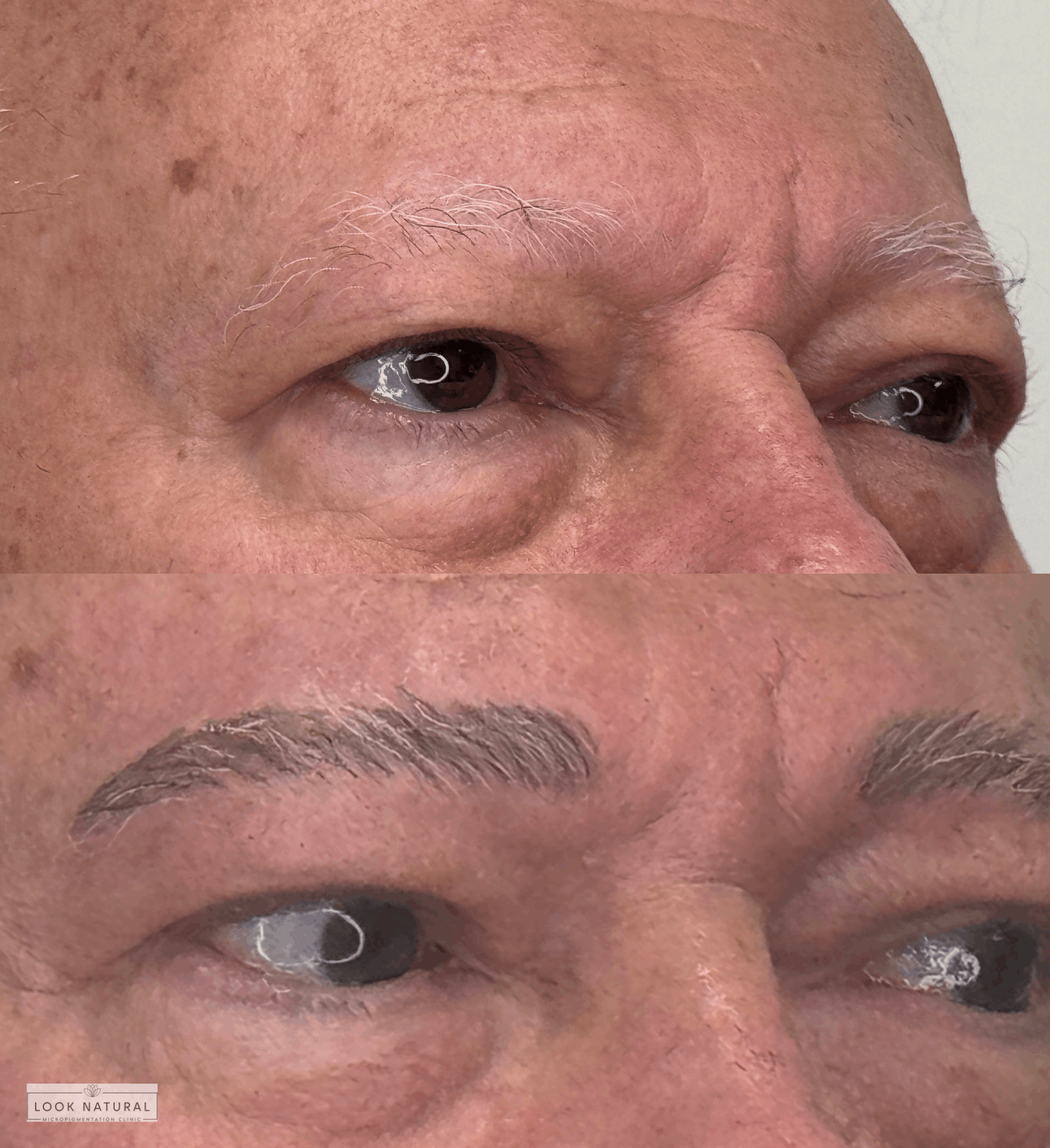 Before and after men’s eyebrow restoration showing natural brow enhancement