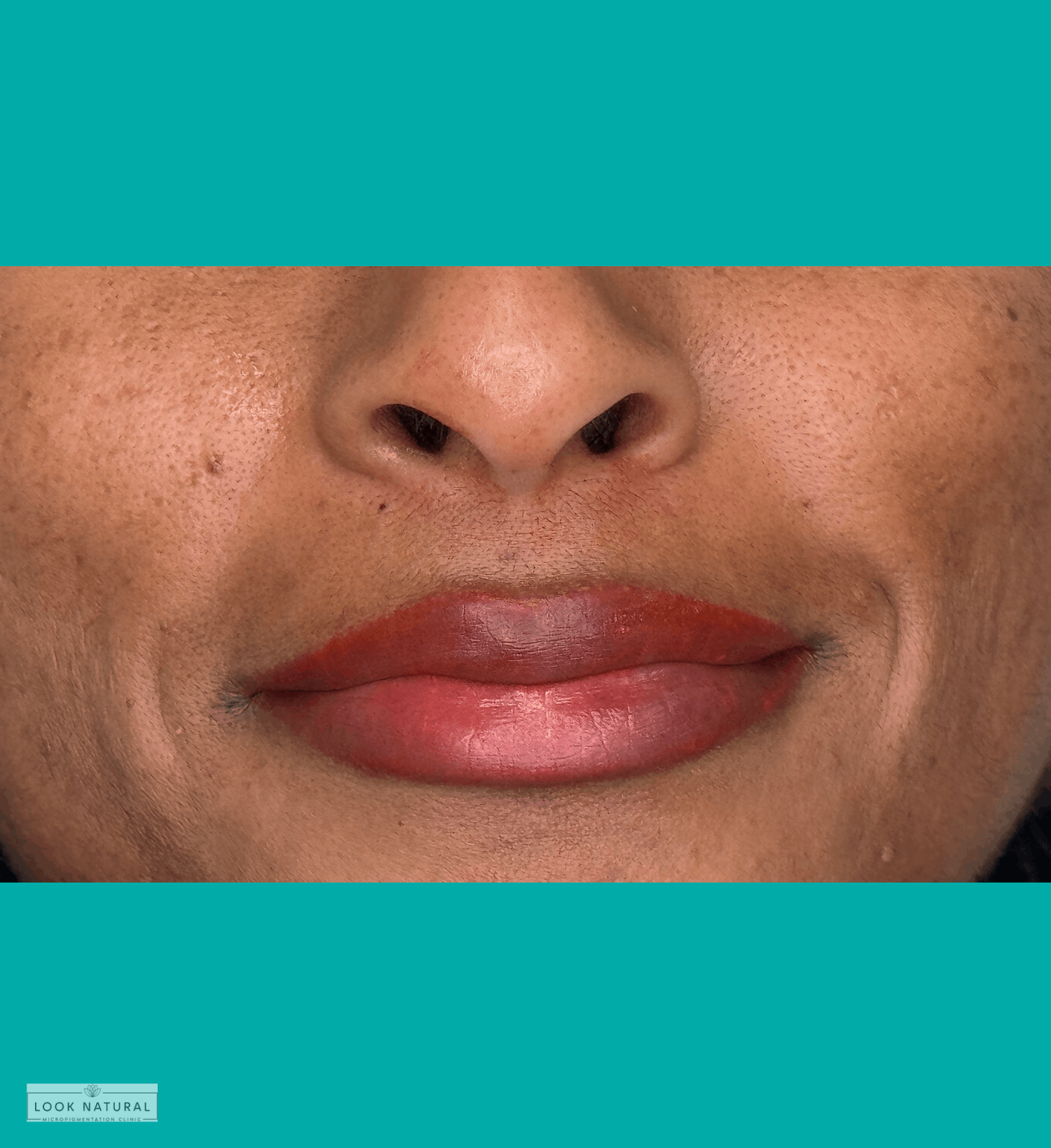 Healed results of lip neutralization treatment on dark lips