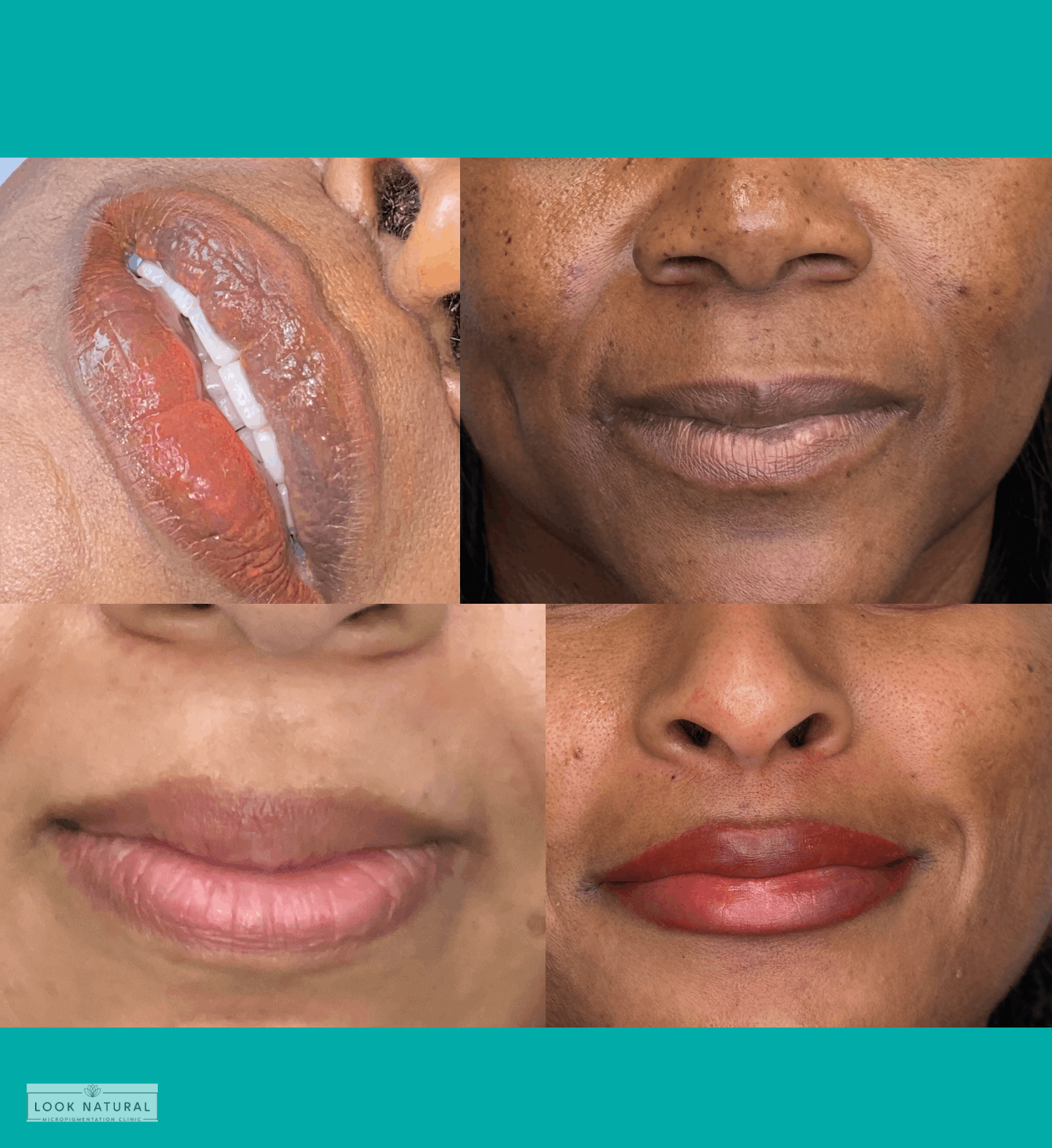 Multiple clients before and after lip neutralization and lightening treatments
