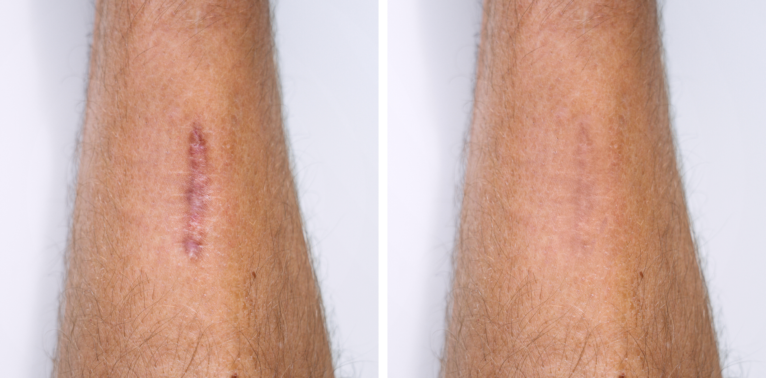 Arm scar before and after camouflage tattooing